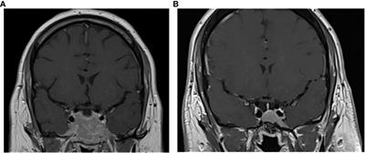 Case report: Complete restoration of the HPA axis function in Cushing’s disease with drug treatment